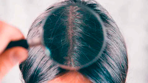 eliminar caspa arganour