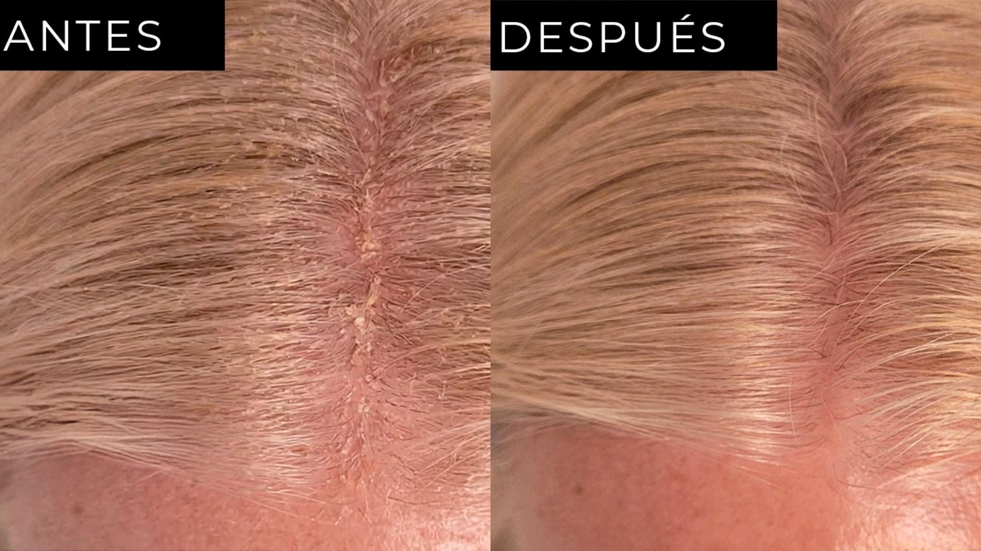 dermatitis cuero cabelludo