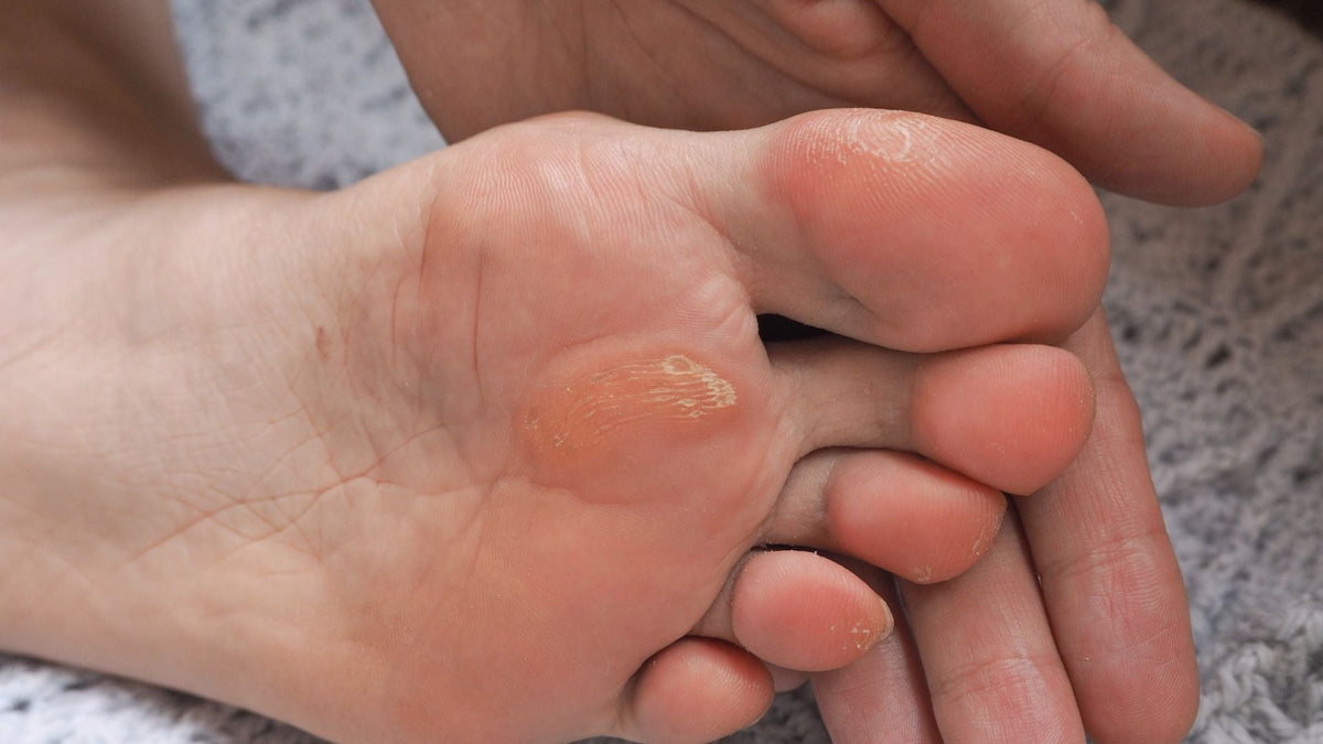 durezas en los pies
