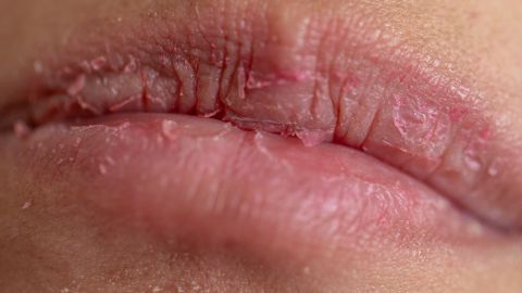 labios secos y agrietados