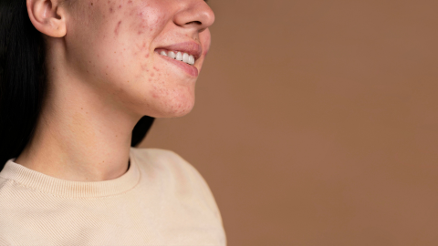 mitos acné
