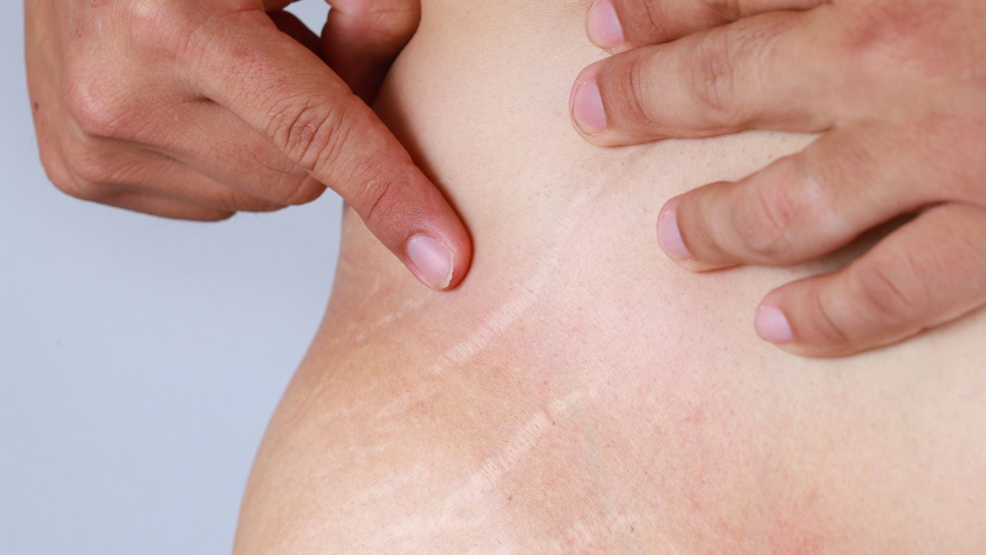 prevenir estrias