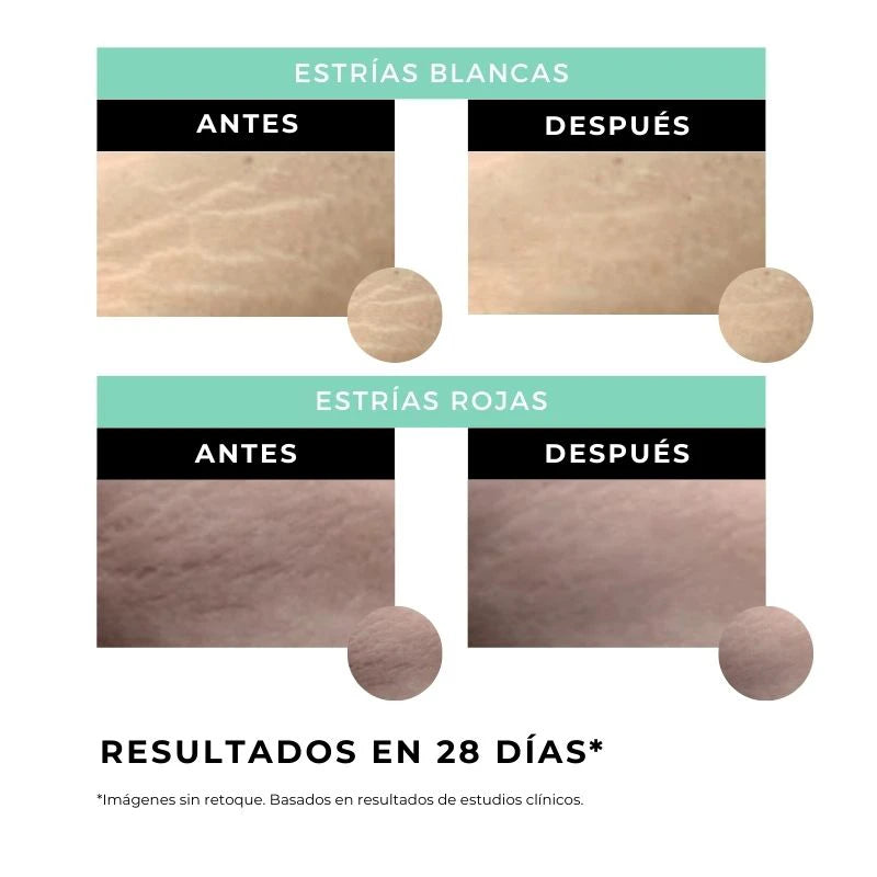 antiestrias antes y despues