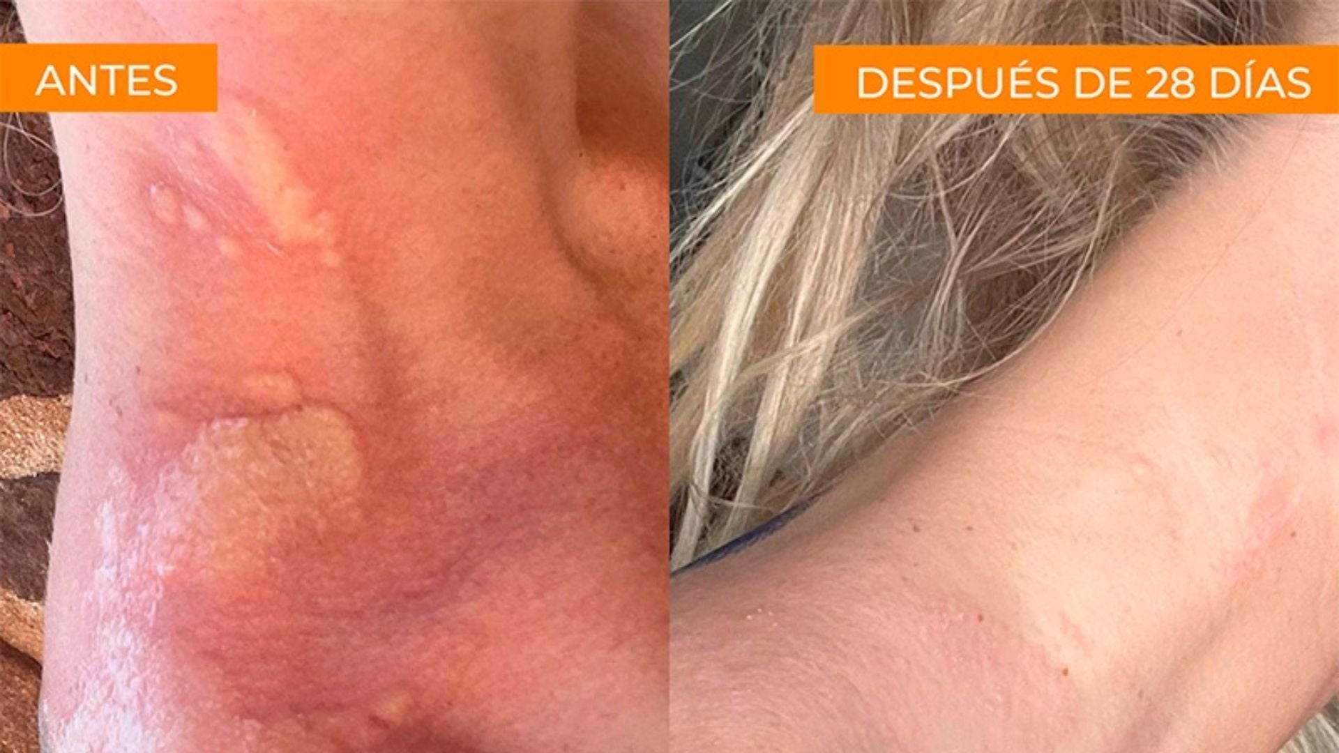 picadura medusa crema