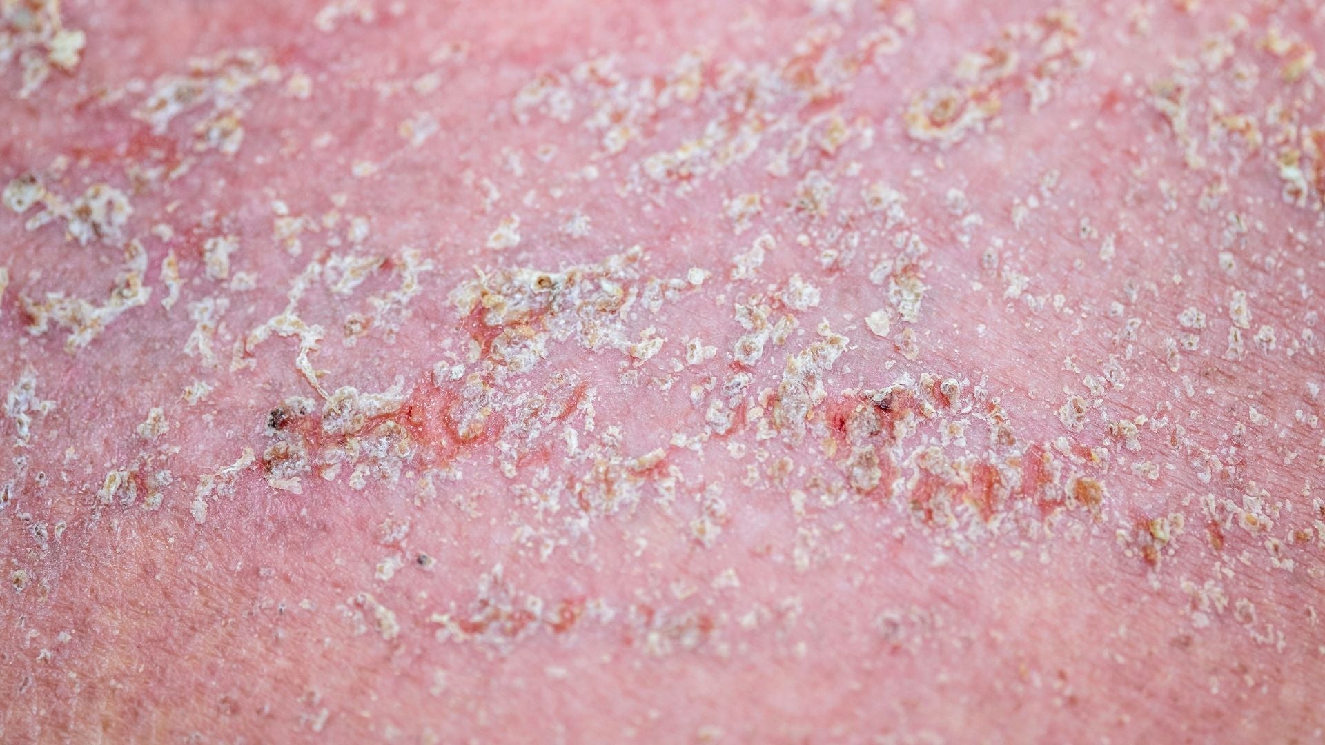 dermatitis seborreica arganour