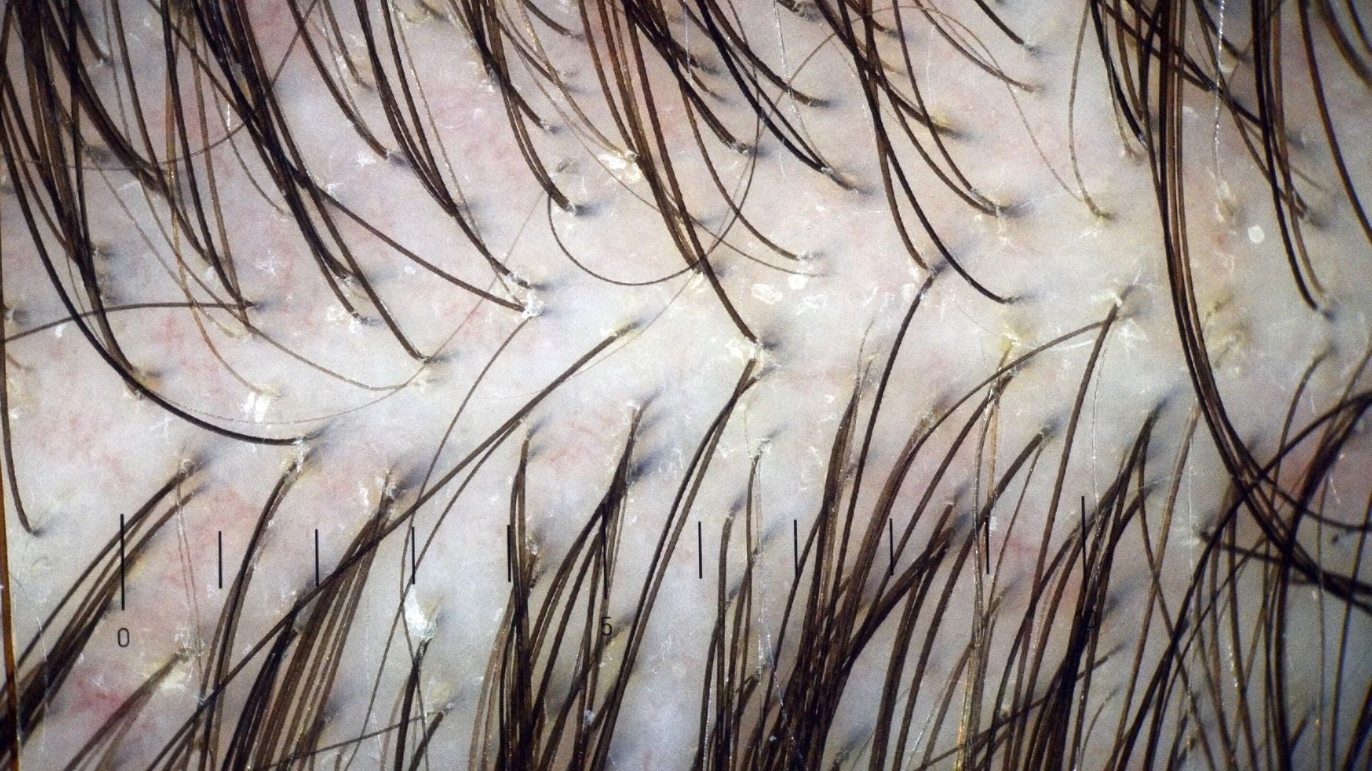 errores exfoliar cuero cabelludo