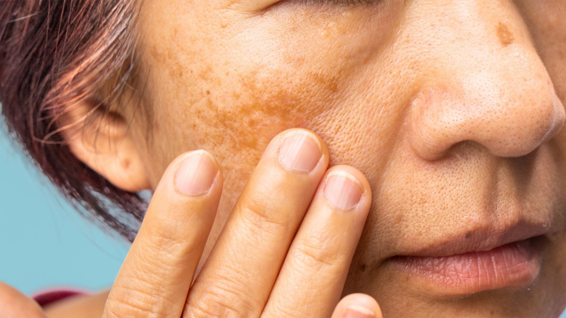 melasma