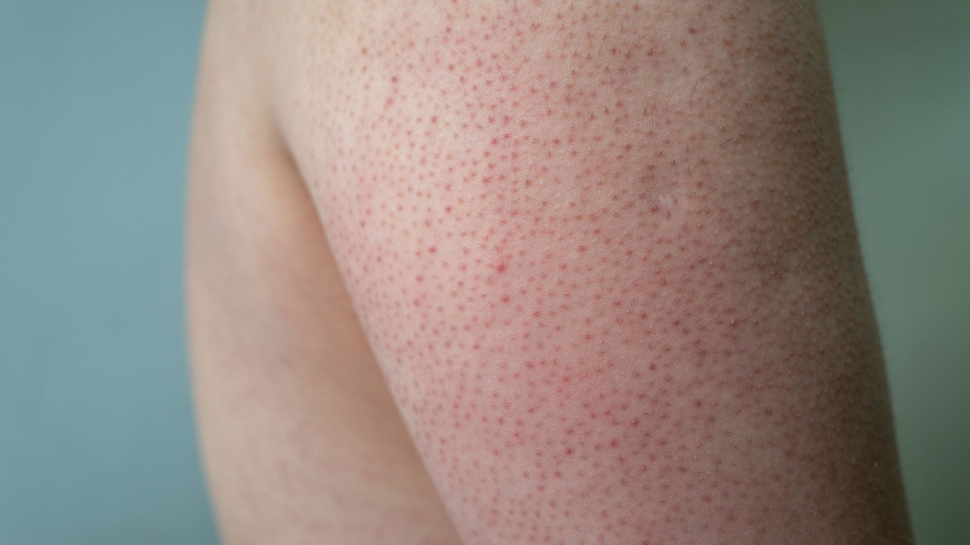 queratosis pilar
